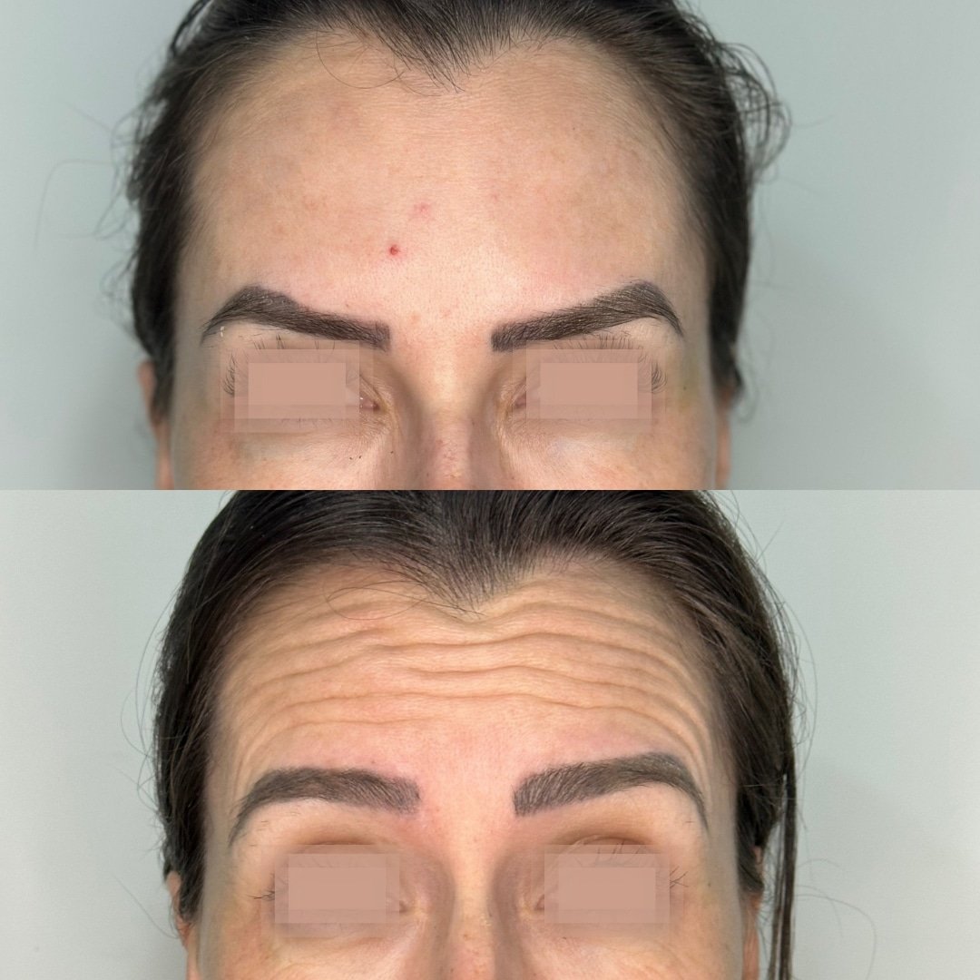 Botox Dra. Endiara V2