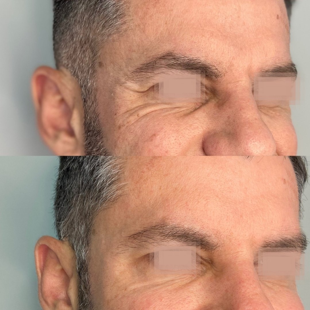 Botox