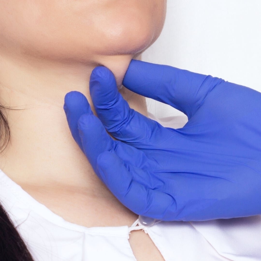 Lipo de Papada Dr. Marcilio Ribeiro